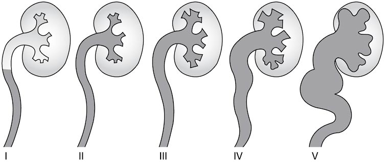 reflux