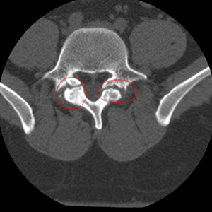 ctscan-lumbar-spine2